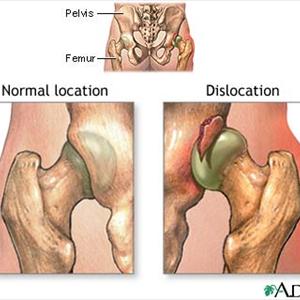 Sciatica Diagrams - Natural Sciataca Relief