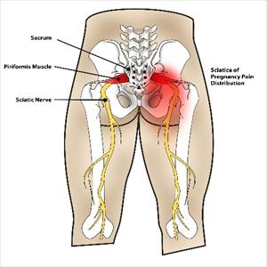 Eat Right For Sciatica - Back Pain Relief Using The DRX9000 - No Inversion Table Hang Ups Here