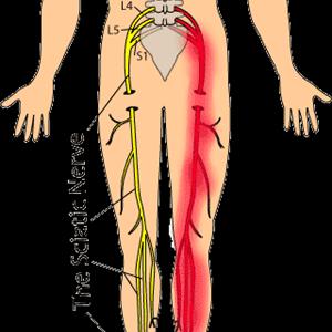  Natural Treatment For Sciatica