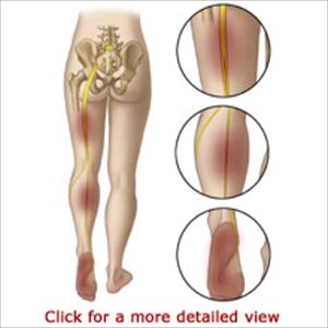 Dealing With Sciatica - Relief From Sciatica Back Pain
