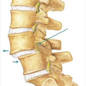 Sciatic Nerve Cushion Pictures - How To Treat Sciatica Nerve Pain