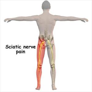 Sciatic Never Exercises - Certified Rolfing 10 Series- Treating Sciatica And Sleeve