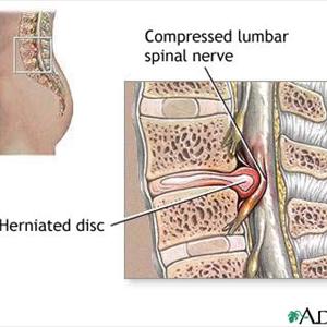 Sciatica Treatment - SCIATICA - AYURVEDA