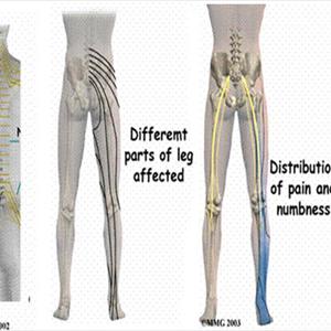 Sciatica Squats - Different Type Of Exercises