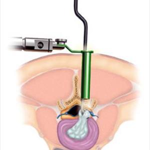 Sciatica Supplements 