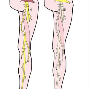 Sciatica Injury - Different Type Of Exercises