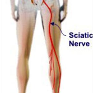  Sciatic Nerve Pain