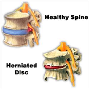 Sciatica Sitting - Sciatica