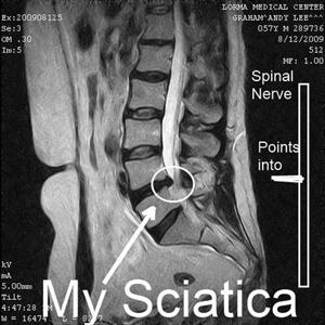 Sciatica Nutritional Supplements - Different Type Of Exercises