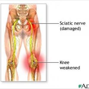 Sciatica Nerve Problems 