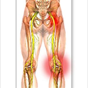 Sciatica Pain Remedies 