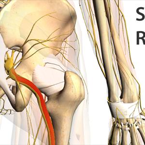 Sciatica Symptoms Buttock Sciatica Treatment - Ischias: Sciatic Nerve Or Sciatica