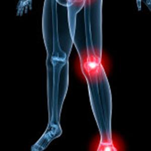 Sciatica Mayo - Living With Sciatica