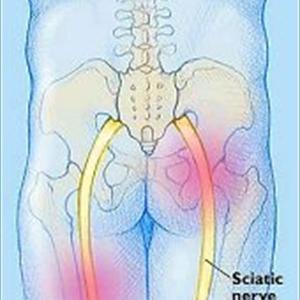 Sciatica Running Exercises Diagnostic 