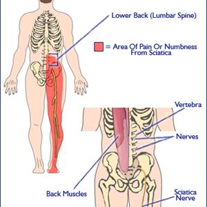 Traditional Chinese Sciatica Pills 