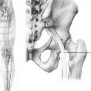 Persistent Sciatic Artery 