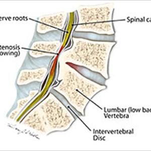 Sciatica Cushions - Exercises  For Sciatica