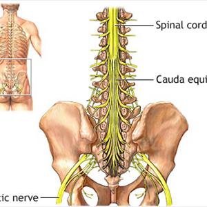 Sciatic Nerve Causes 